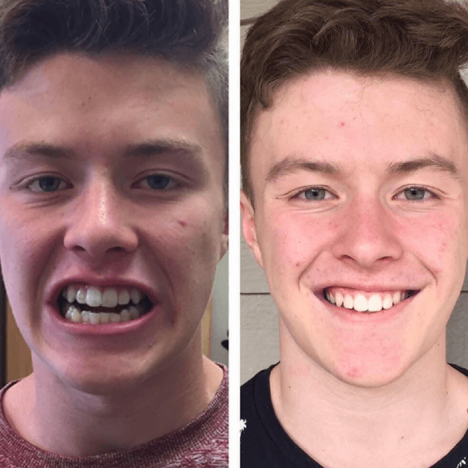 Invisalign - Mais rápido